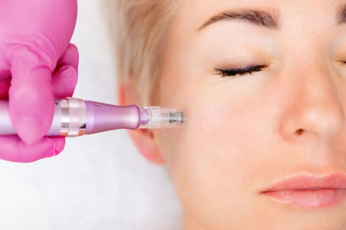 Microneedling - Charlie Walker PMU