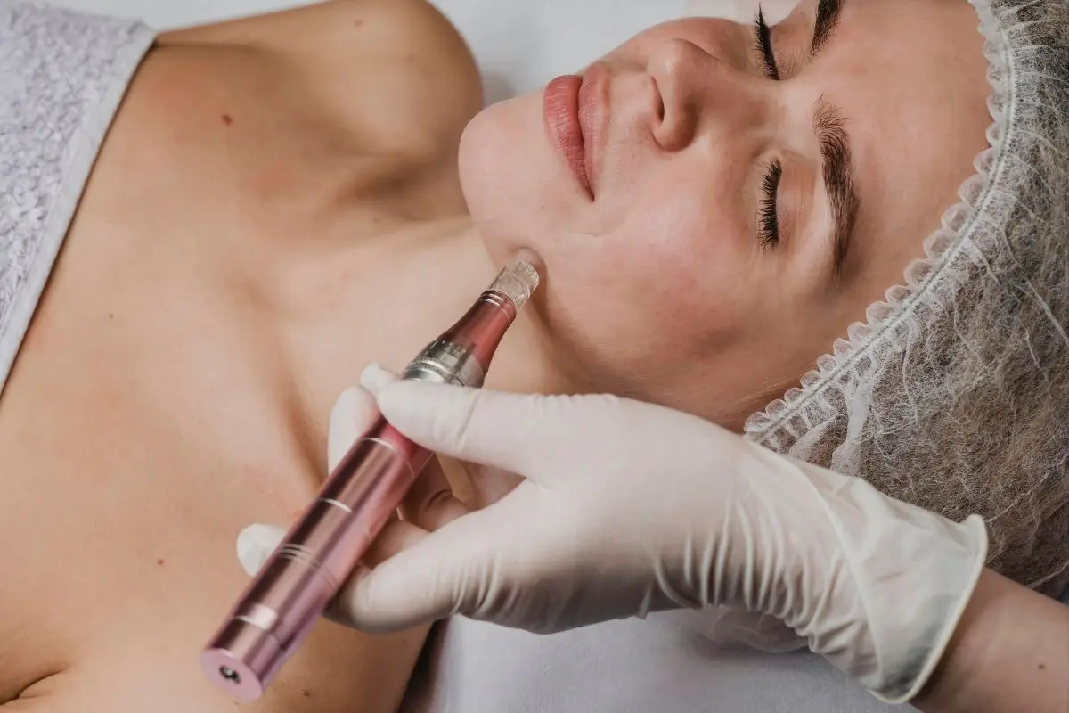 Microneedling - Charlie Walker PMU